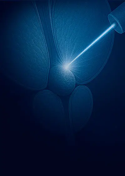 Laserska operacija prostate HoLEP metodom pomoću holmijum lasera