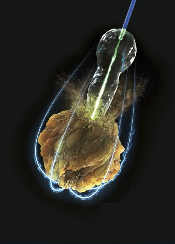 Prikaz holmijum lasera koji preciznim snopom energije razbija urinarni kamenac tokom minimalno invazivne urološke procedure