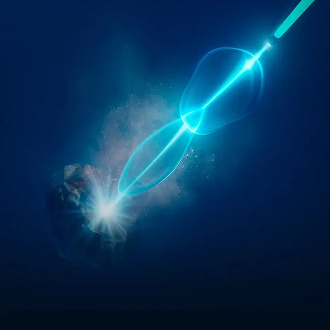 Laserska sonda razbija bubrežni kamen tokom holmijum laserske litotripsije