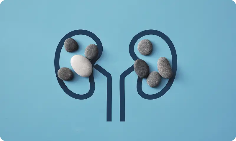 Ilustracija bubrega sa kamenčićima koji predstavljaju urolitijazu i nastanak kamena u urinarnom traktu