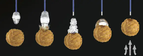 Lasersko razbijanje kamena u bubregu, ureteru i bešici holmijum laserom